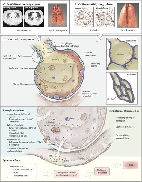 Ventilator Induced Lung Injury New England Journal Of Medicine