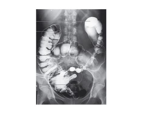 Enterostomy Quiz