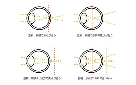 画像 【子どもの近視】今すぐできる進行予防行動2つ 裸眼視力03未満の小学生は30年前の3倍以上 ｢病気｣と｢症状｣の対処法