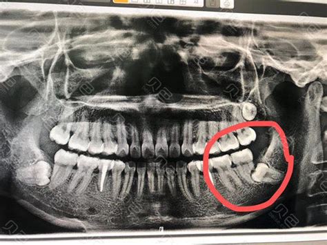 智齿科普专辑智齿一定要拔掉吗哪些智齿必须拔除 贝色口腔