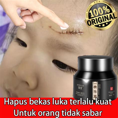 Jual Salep Penghilang Bekas Luka Menghilangkan Bekas Luka Penghilang