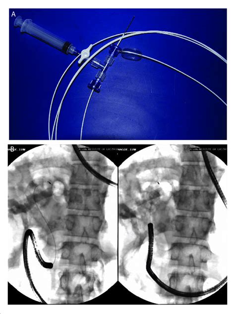 A Cook Cholangioscopy Access Balloon B An Ultraslim Endoscope Being