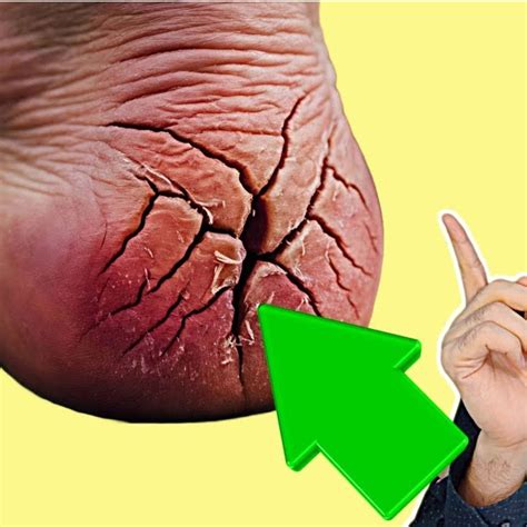 Use These Amazing Treatments to Get Rid of Cracked Heels Permanently