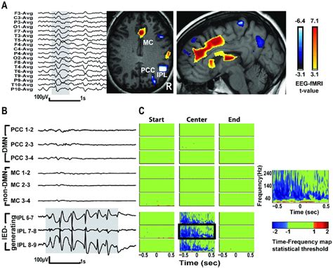 Eeg Fmri Results And Time Frequency Tf Statistical Maps Of Seeg