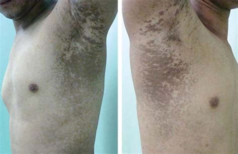 Lichen Planus Causes What It Looks Like And How To Get Rid Of It