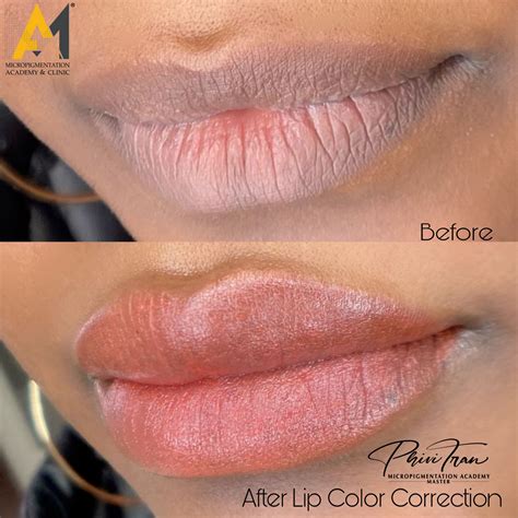 Best Permanent Lip Contour Treatment Wethersfiled CT