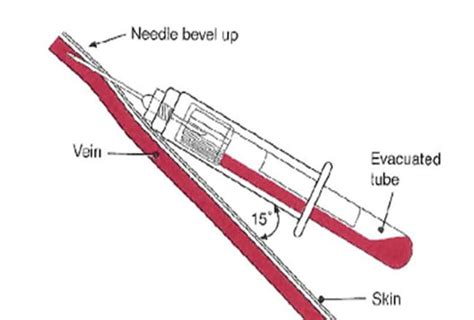 Venipuncture And Arterial Puncture Policy Phlebotomy Study