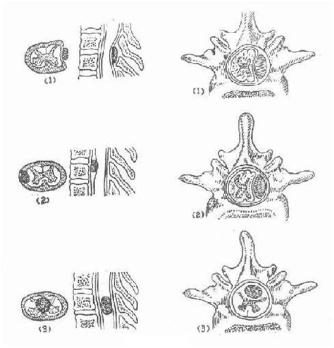 頸椎管內原發性椎管內腫瘤如何確定脊髓受壓平面 每日頭條