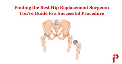 Finding The Best Hip Replacement Surgeon Your Guide To A Successful