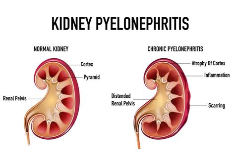 Pyelonephritis – Symptoms, Causes & Treatment – Costamedic