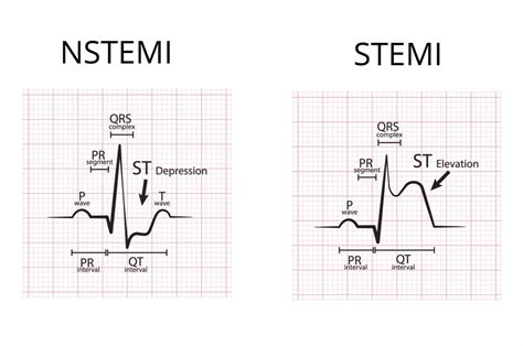 Nstemi Vs Stemi On Ekg