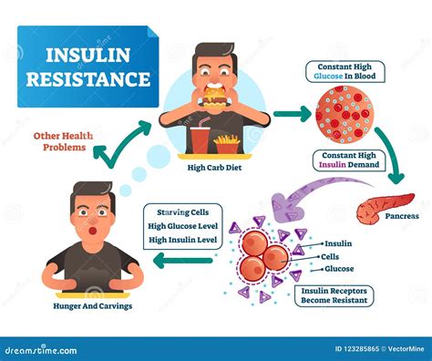 Ejemplo Del Vector De La Resistencia A La Insulina Esquema Etiquetado