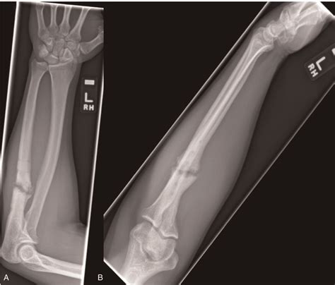 A Ap And B Lateral Radiographs At 6 Month Follow Up When The Download Scientific Diagram