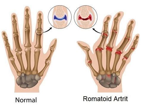 Romatoid Artrit Hastalığı Belirtileri Nedenleri ve Tedavisi