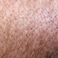 What Is Weeping Eczema?