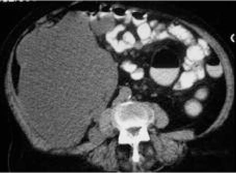 Retroperitoneal Cystic Mass Download Scientific Diagram