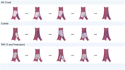 Contemporary Complex Bifurcation Stenting Techniques For Left Main