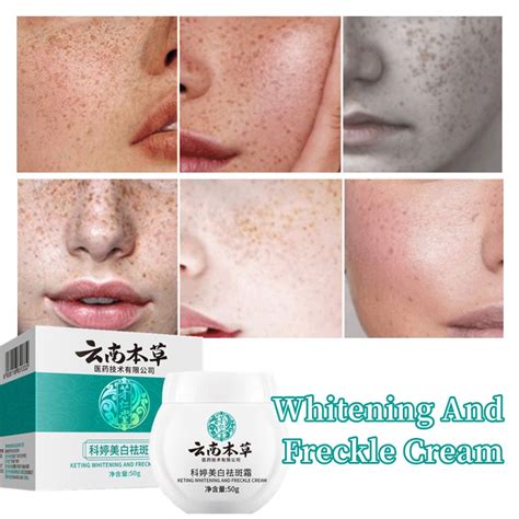 Keting Whitening And Freckle Cream G Nicotinamide Melasma Cream