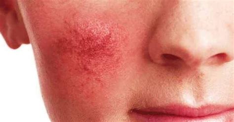 Dermatologia Studio Acne Fa Scudo Contro Segni Invecchiamento