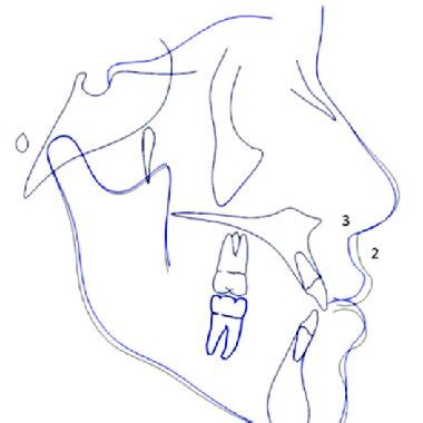 SUPERIMPOSITION Of The Mean Tracings A Superimposition Showing 1