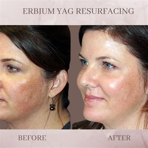 Erbium Skin Resurfacing Eluma Laser Aesthetics