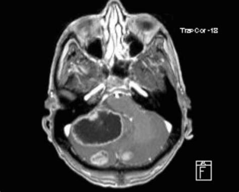 -Axial Cerebral MRI with evidence of three cerebellar lesions. The ...