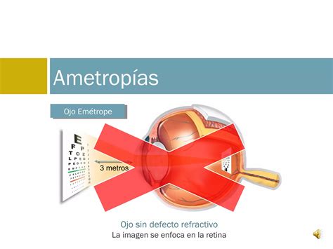 Ametropías Ppt