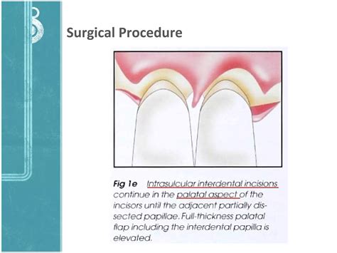 Simplified Papilla Preservation Technique Ppt