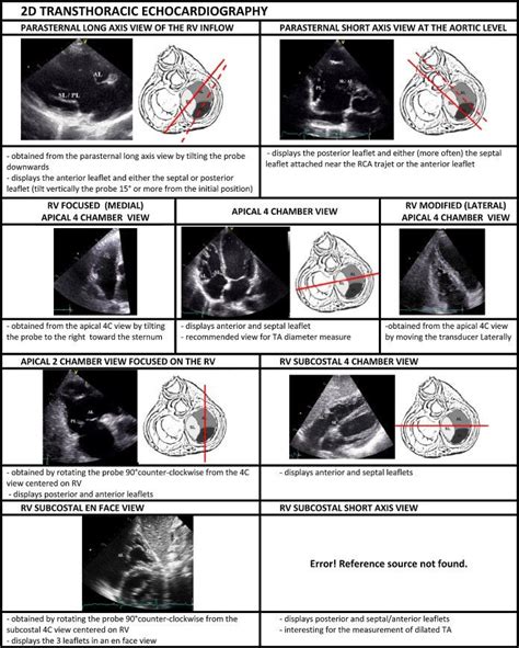 Pin by Kara on Kardio | Cardiac sonography, Ultrasound, Tricuspid valve