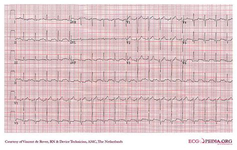 Endocarditis Ecg