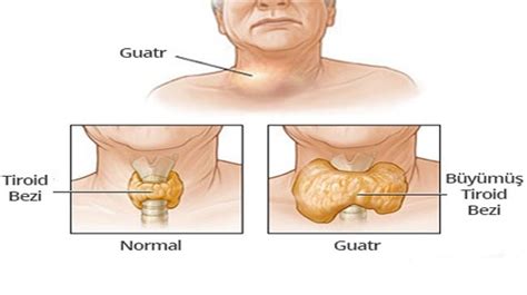 Guatr ve Tiroid Nodülleri Genel Cerrahi Uzmanı