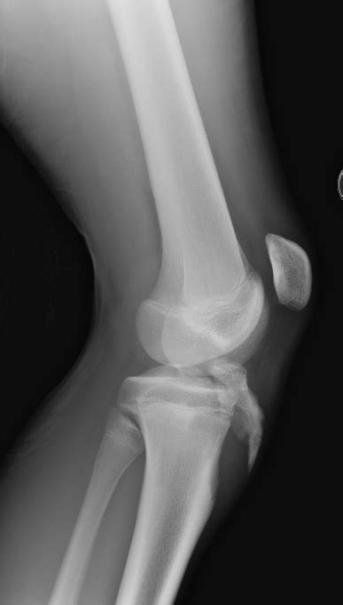 Epiphyseal Fracture Classification