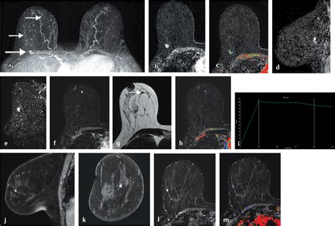 What Does Inflammatory Breast Cancer Look Like On Mri at Anthony ...