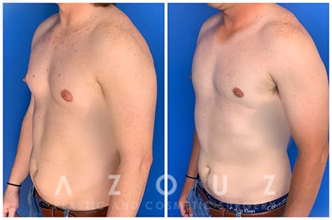 Dallas TX Nipple Reduction Surgery Plano Areola Reduction Surgeon