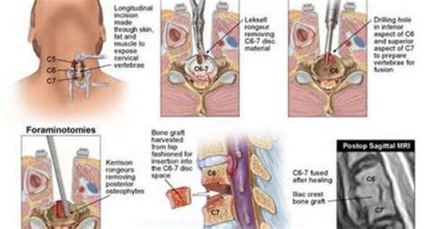 Anterior Cervical Discectomy And Fusion With Fixation Mapasgmaes