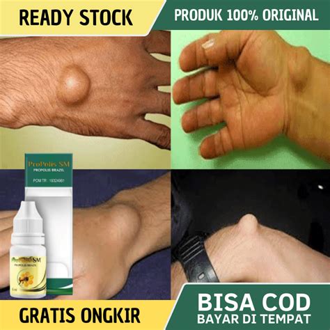 Jual Obat Benjolan Di Tangan Obat Kista Ganglion Obat Benjolan Di