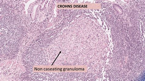 Pathology Of Crohn’s Disease Pathology Made Simple