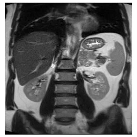 A Coronal T2 Weighted And B Axial Fat Saturated T2 Weighted Images