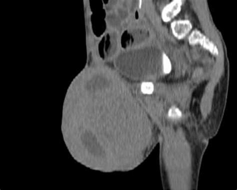 Sagittal Reformatted Enhanced Ct Scan Of The Pelvis Showing A Download Scientific Diagram