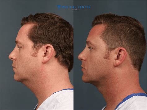 Neck Lift Surgery In Turkey Medical Center Turkey