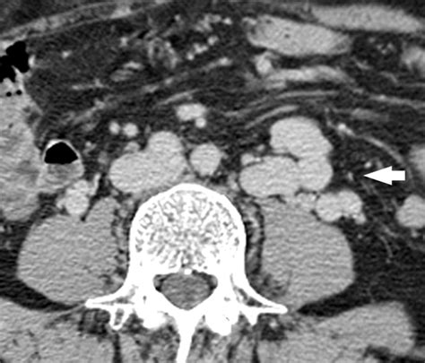 Inferior Mesenteric Vein Gray Scale And Doppler Sonographic Findings