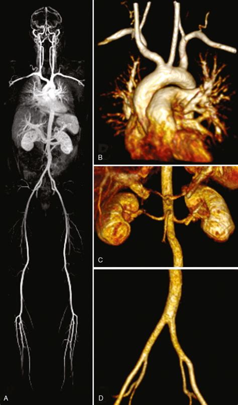 Diseases Of The Aorta Radiology Key