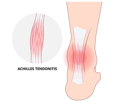 Tendinopathy Symptoms Causes Treatment Edu Svet Gob Gt