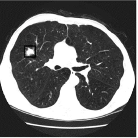 Lung Cancer Nodules Size Chart