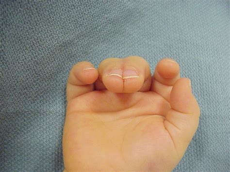 Birth Bilateral Complete Syndactyly Release With Toe Pulp Grafts For