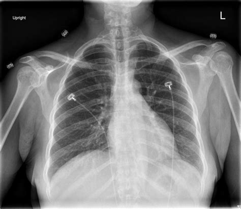 Cervical Ribs Radiology Case Cervical Radiology