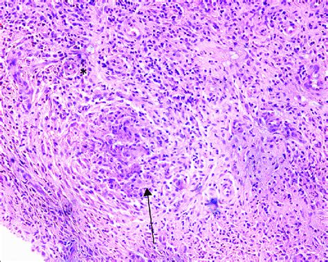 Hematoxalin And Eosin Staining With 100x Magnification Of Synovial