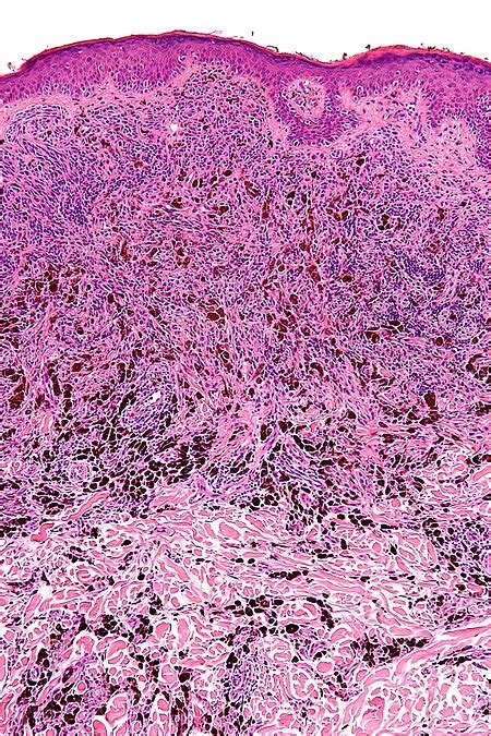 Melanocytic lesions - Libre Pathology