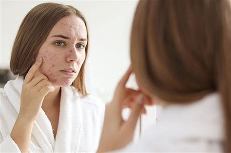 Cómo Quitar Las Manchas De Acné En La Cara Eternia Derma Center