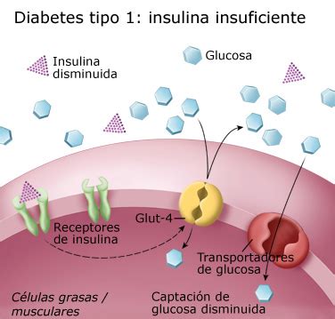 ¿Qué es la Diabetes tipo 1? - Diabetes Education Online